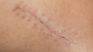Los masajes en la cicatriz favorecen el drenaje linfático, previniendo la inflamación y suavizando la cicatriz