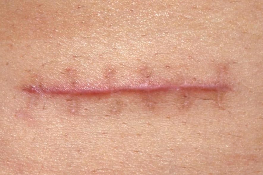(Esp) Cuidado y tratamiento de Cicatrices Quirúrgicas
