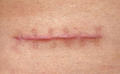 Cuidado y tratamiento de Cicatrices Quirúrgicas