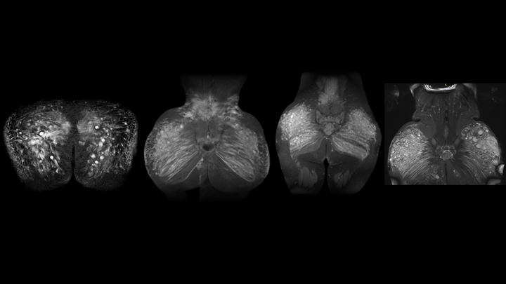 La resonancia magnética (RMN) es fundamental en el proceso de extracción de biopolímeros, porque permite identificar con exactitud la localización, volumen y nivel de infiltración de los biopolímeros en los tejidos.