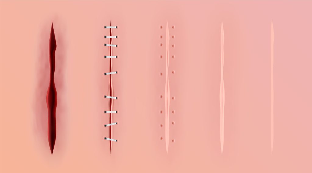 La cicatrización es un proceso biológico ordenado que pasa por tres etapas. Cada una cumple una función específica y necesita cuidados diferentes para favorecer la regeneración del tejido y evitar complicaciones.