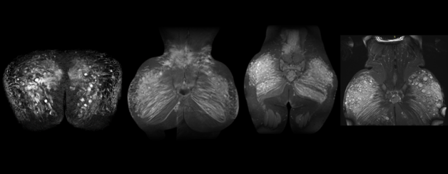 La resonancia magnética (RMN) es fundamental en el proceso de extracción de biopolímeros, porque permite identificar con exactitud la localización, volumen y nivel de infiltración de los biopolímeros en los tejidos.